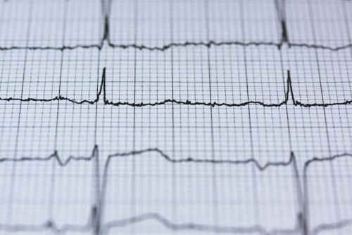 Fibrillation auriculaire : prise en charge optimisée selon les dernières recommandations - CONGRES CNCH 2026